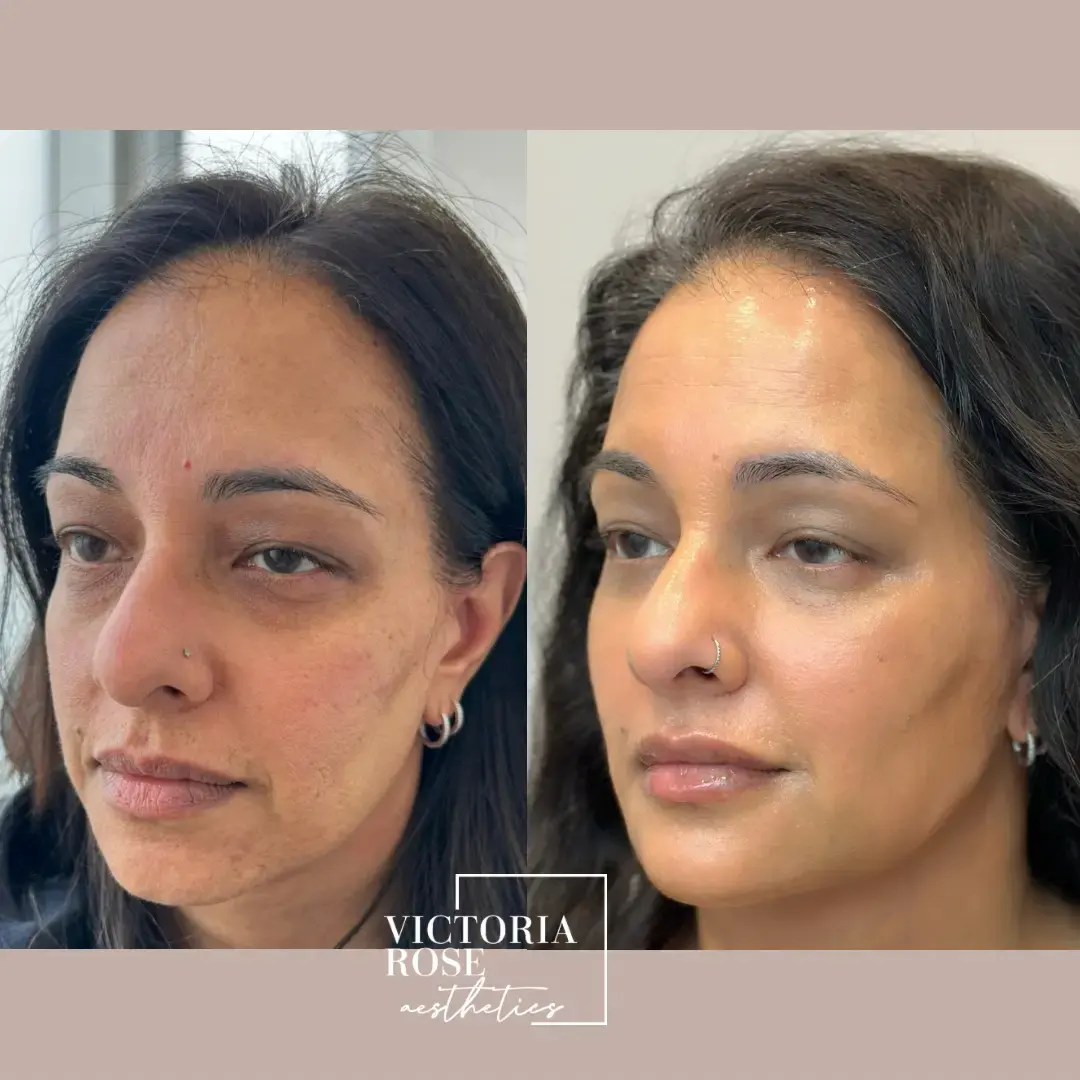 4D facelift before and after