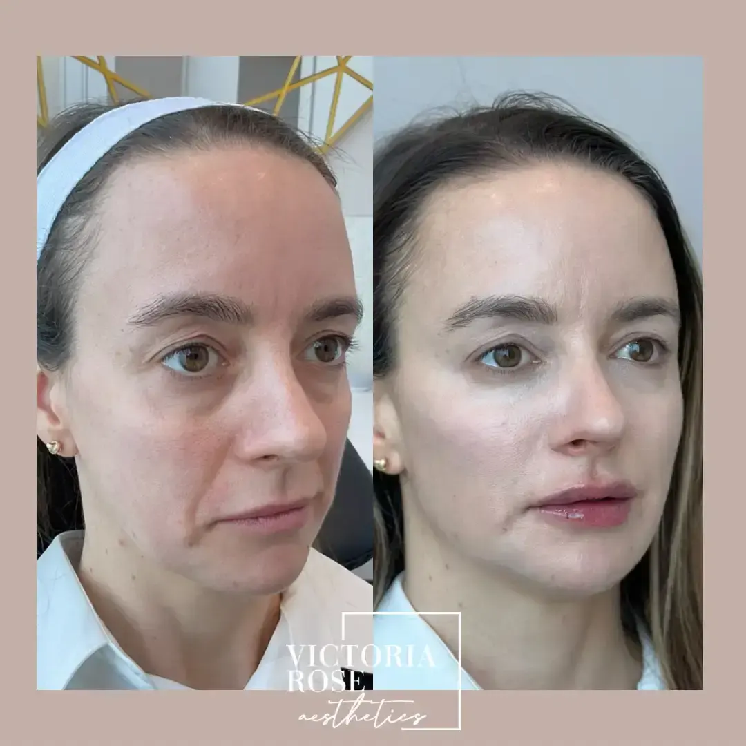 4D facelift before and after