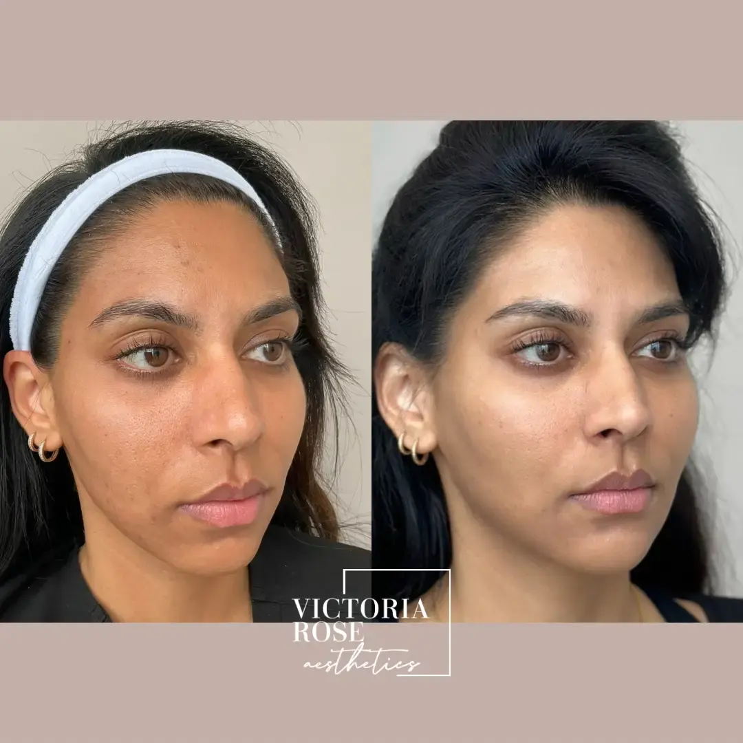4D facelift before and after