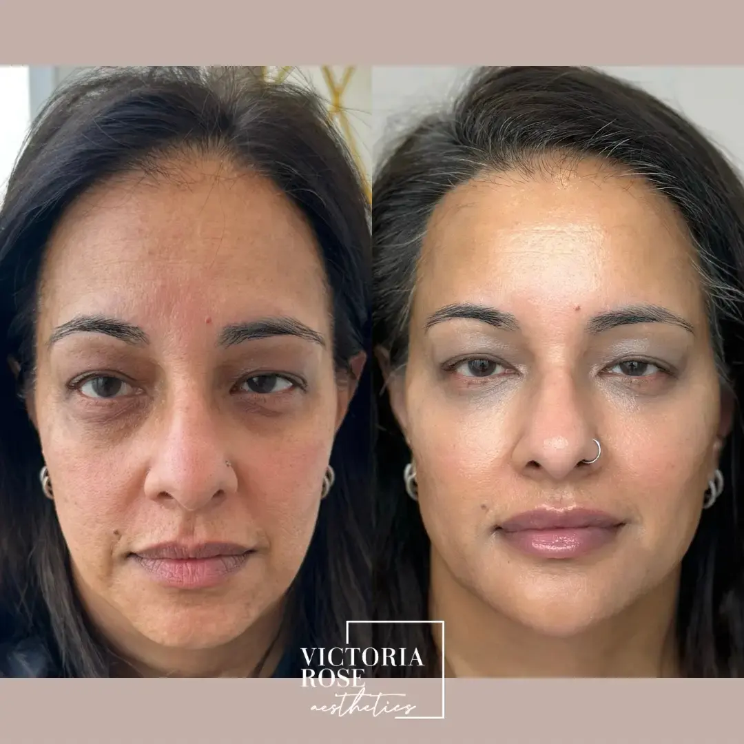 4D facelift before and after