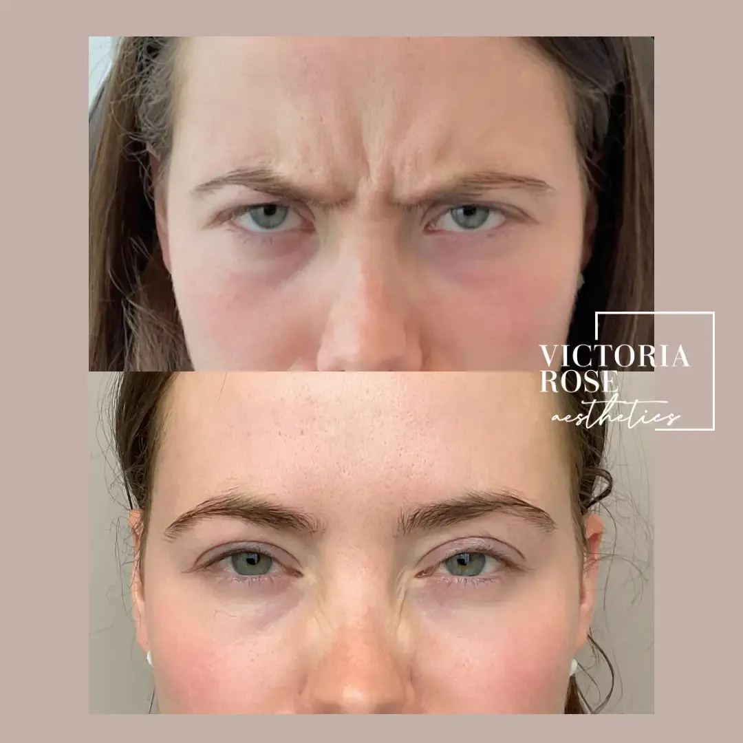 Botox before and after