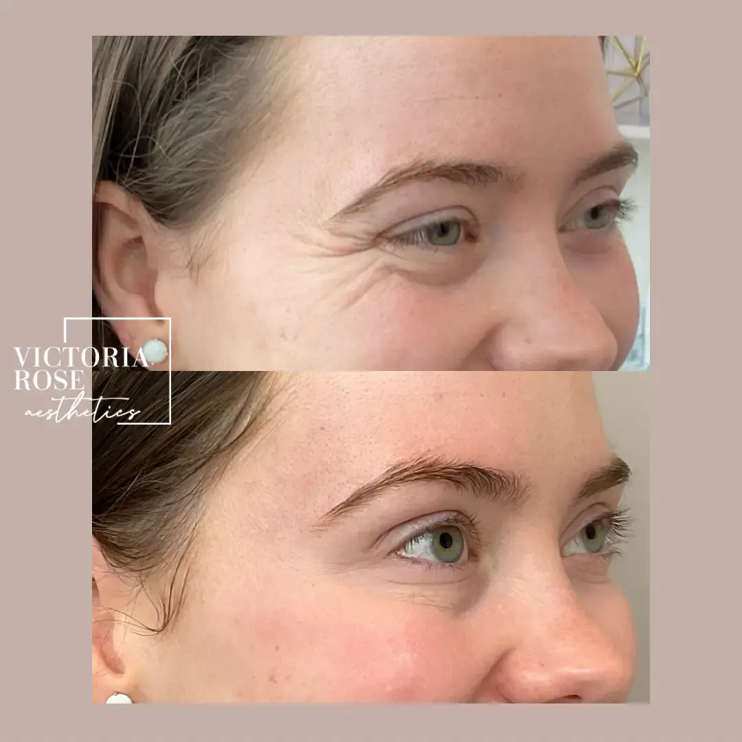 Botox before and after