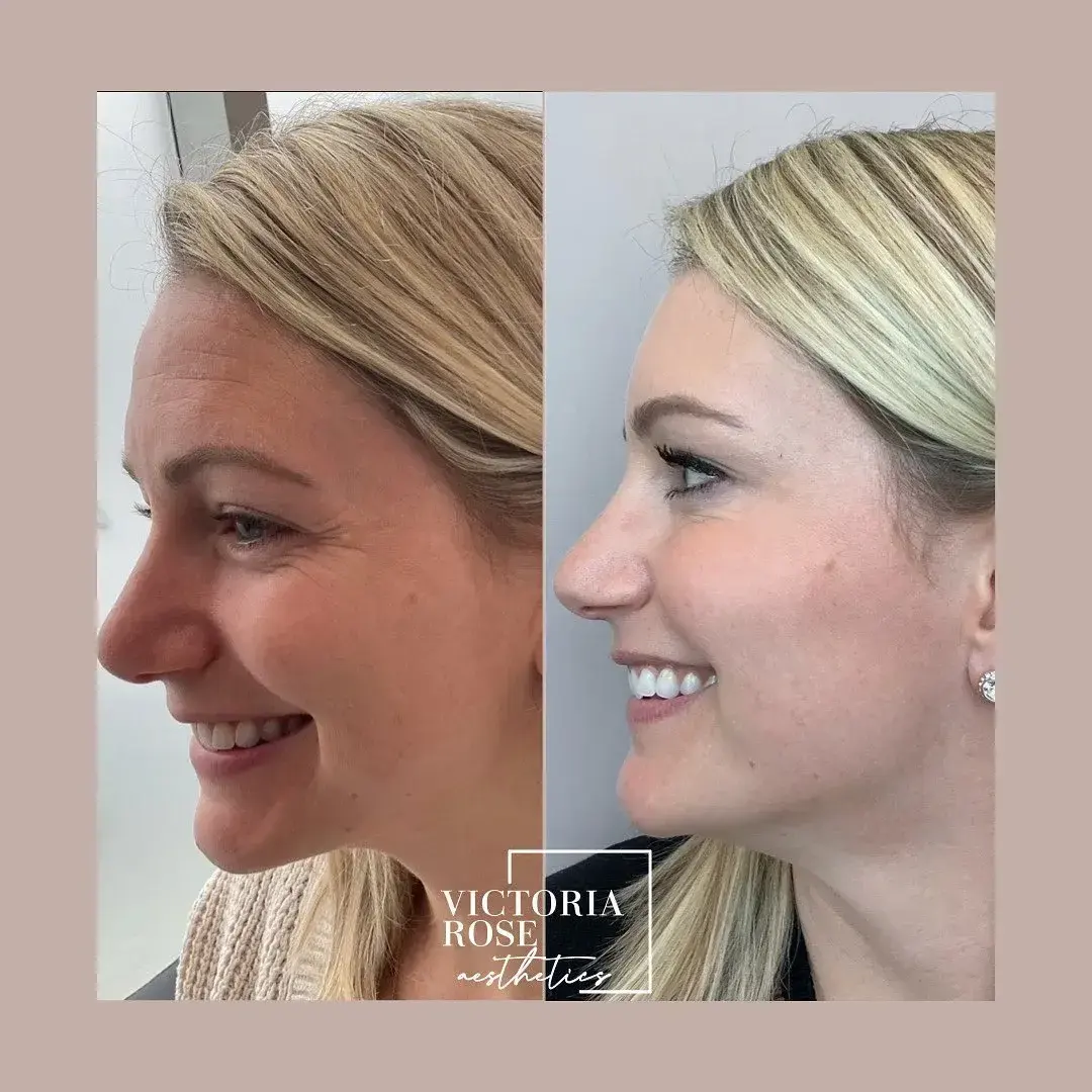 Botox before and after