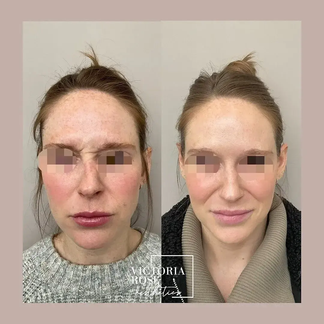 Botox before and after