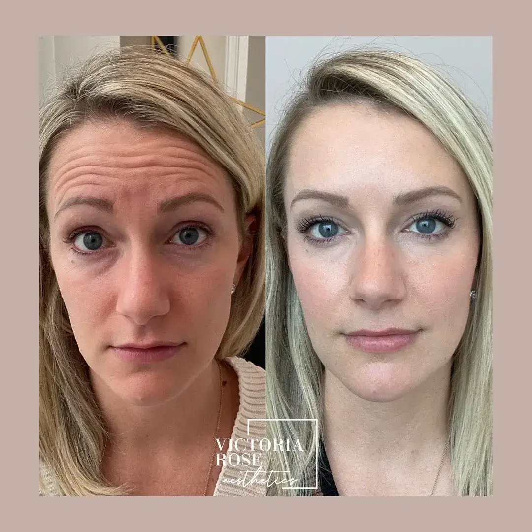 Botox before and after