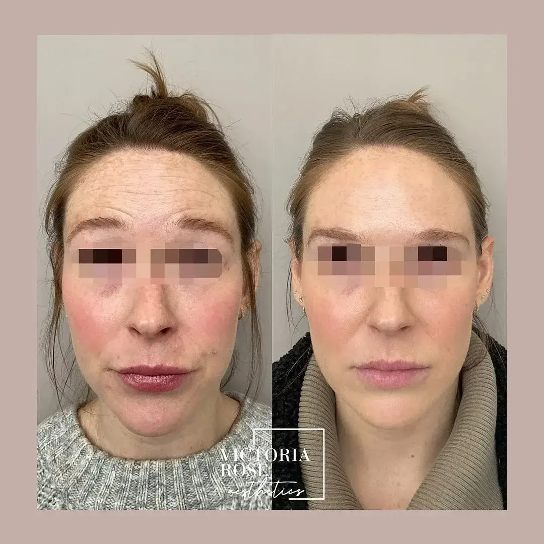 Botox before and after