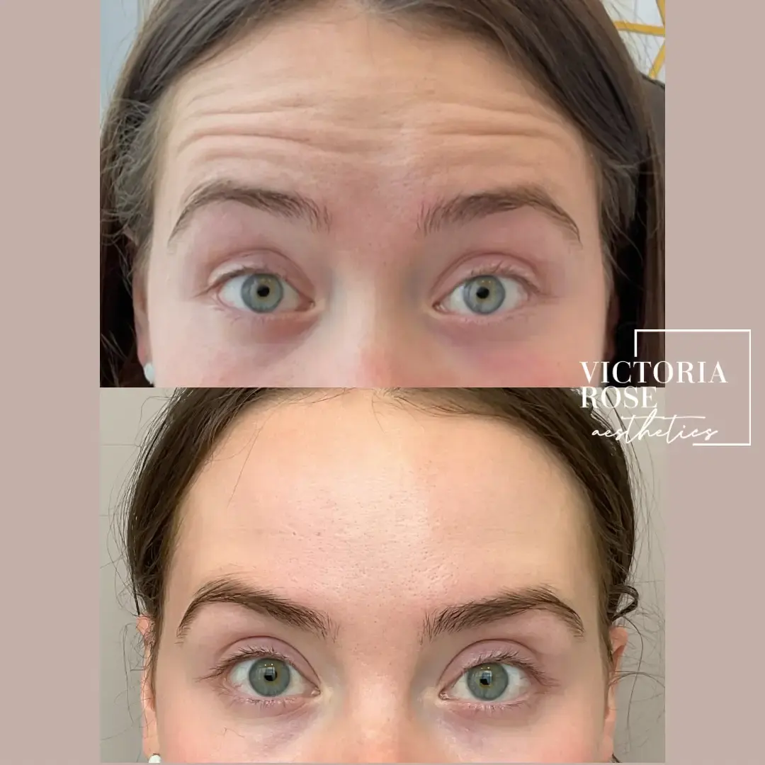 Botox before and after