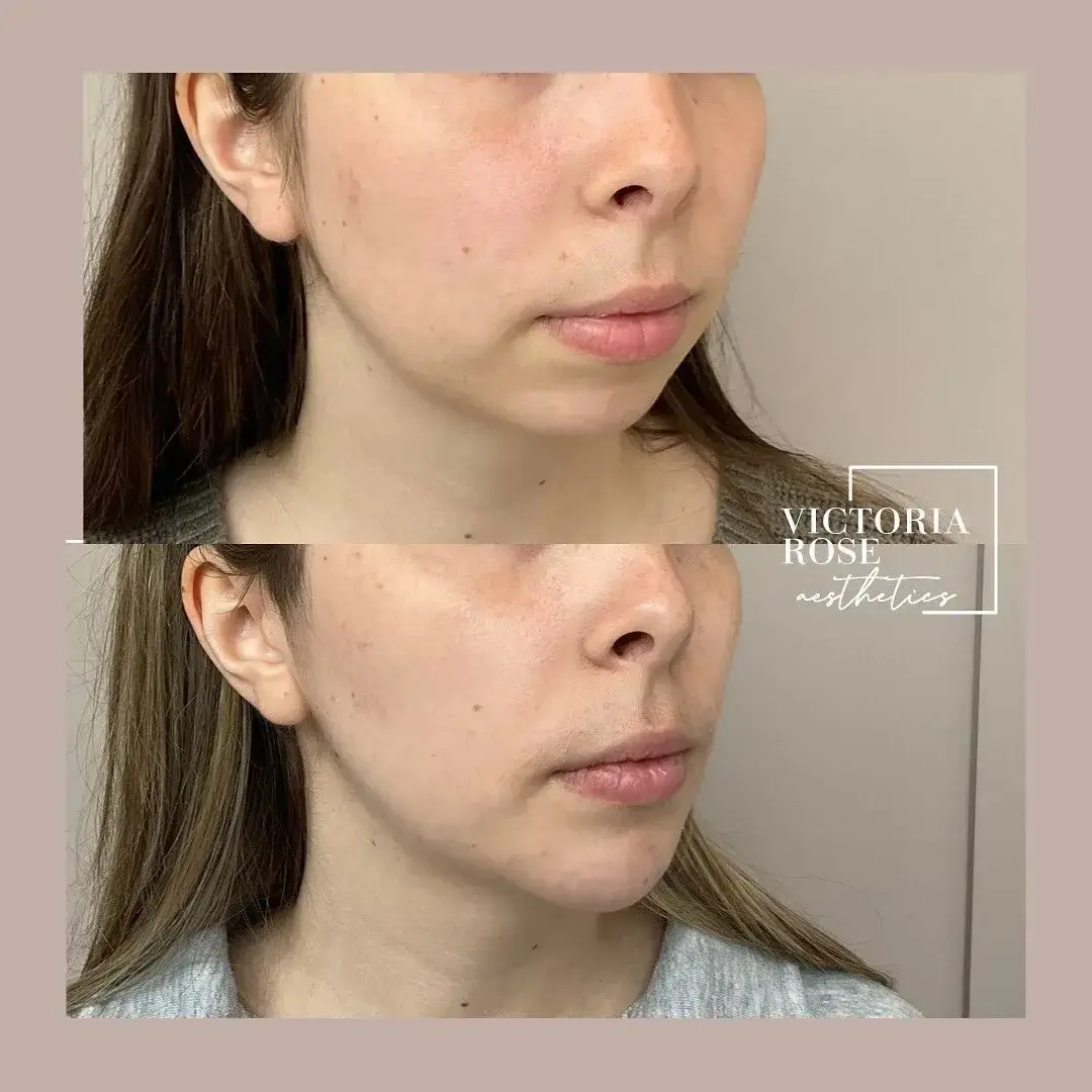 Chin filler before and after