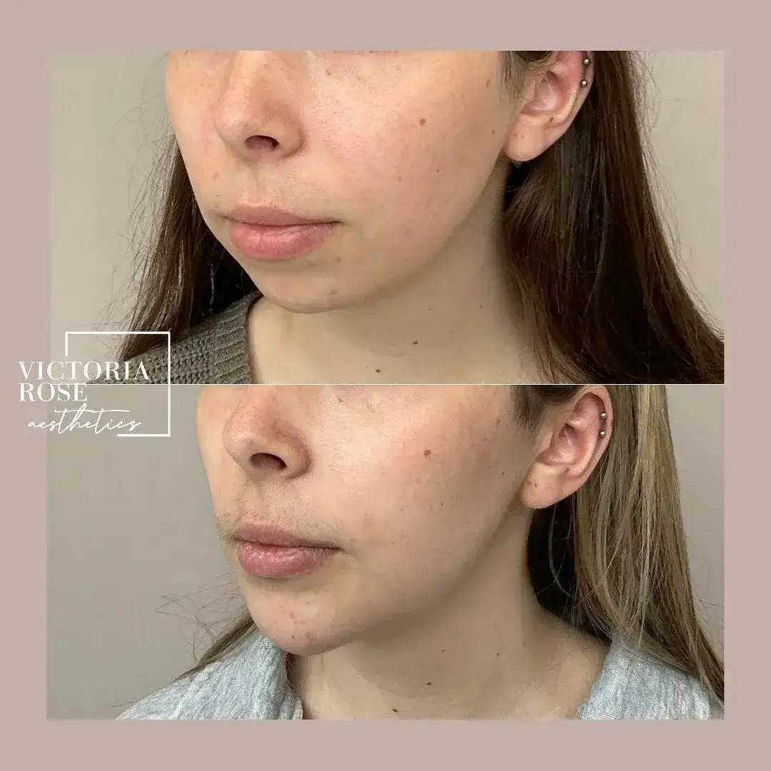 Chin filler before and after
