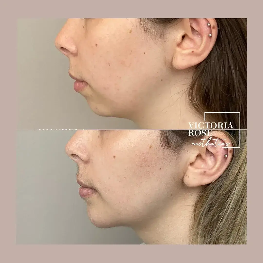 Chin filler before and after