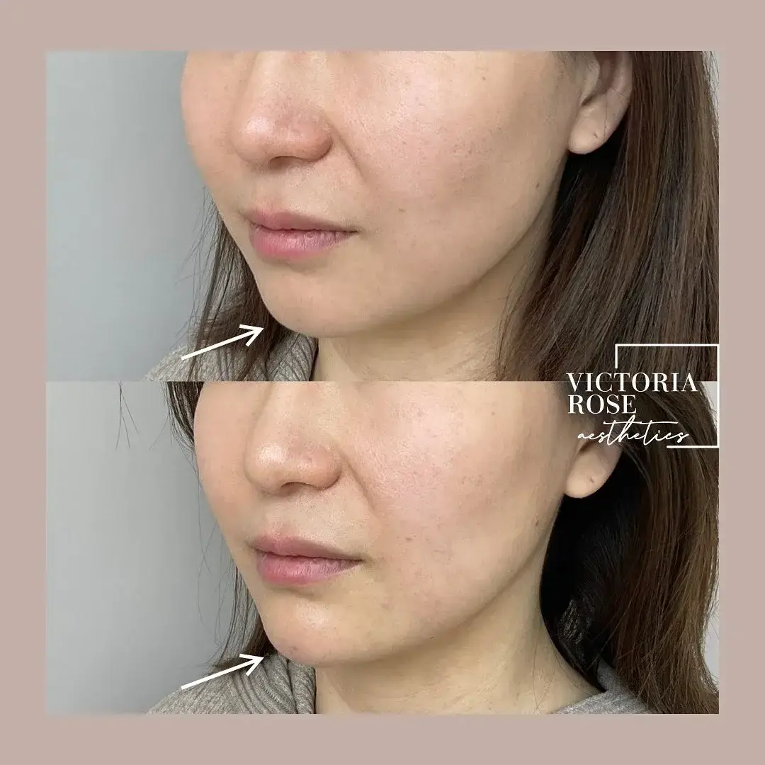 Chin filler before and after