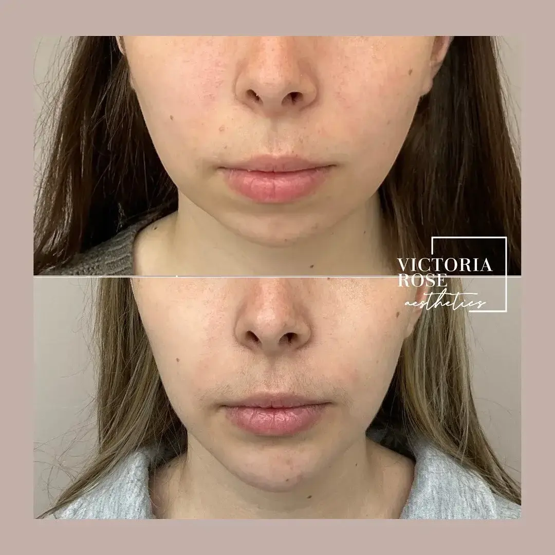Chin filler before and after