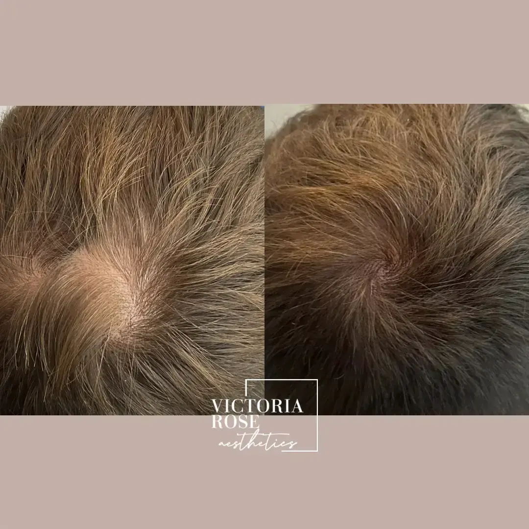 Hair restoration before and after