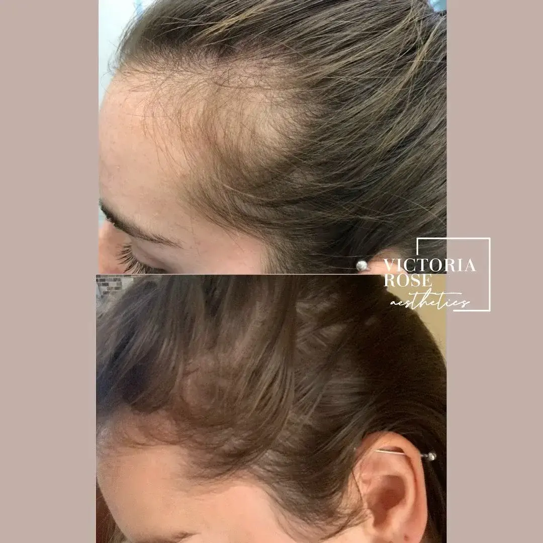 Hair restoration before and after