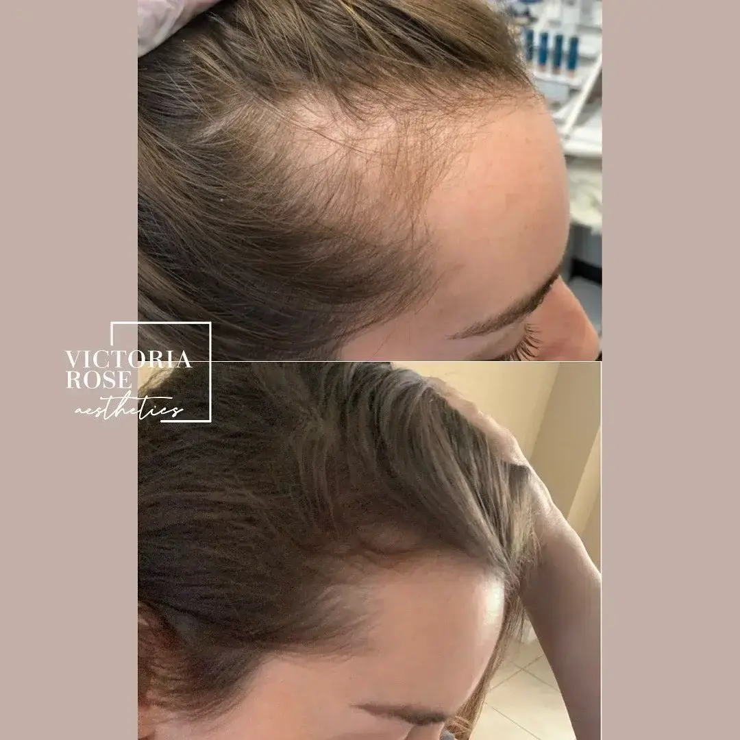 Hair restoration before and after