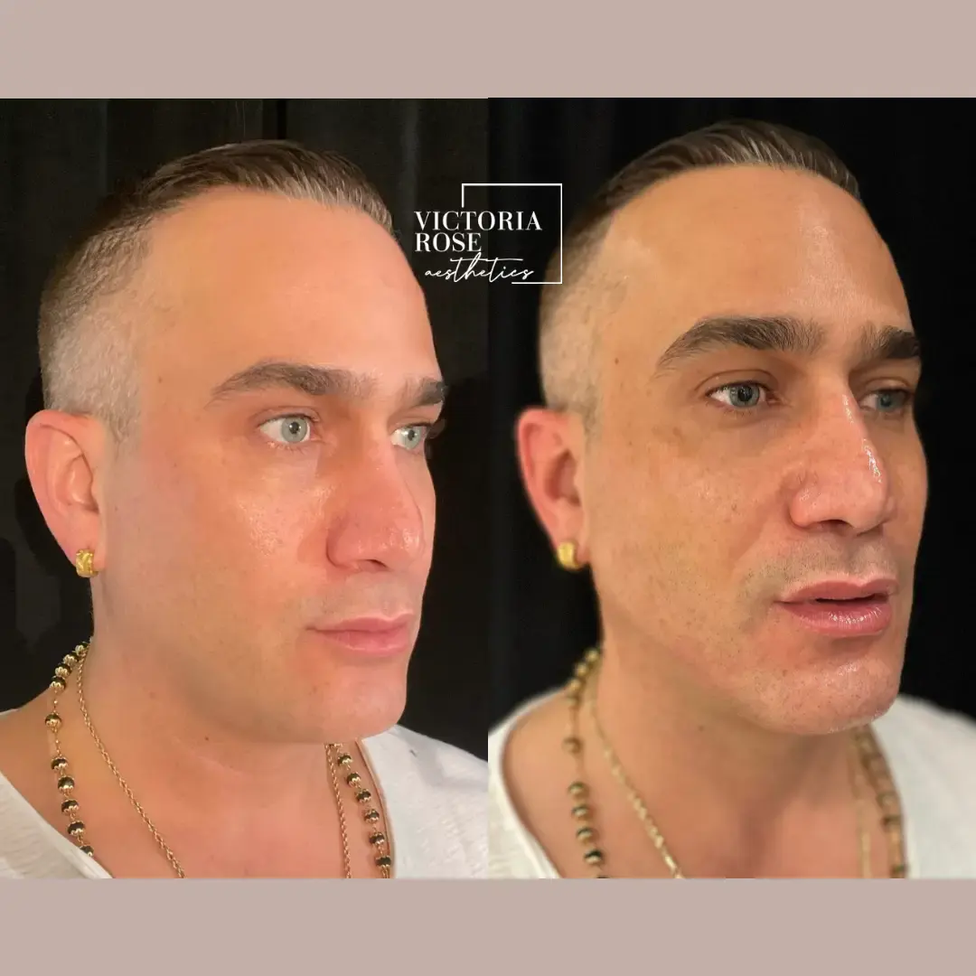 Jawline contouring before and after