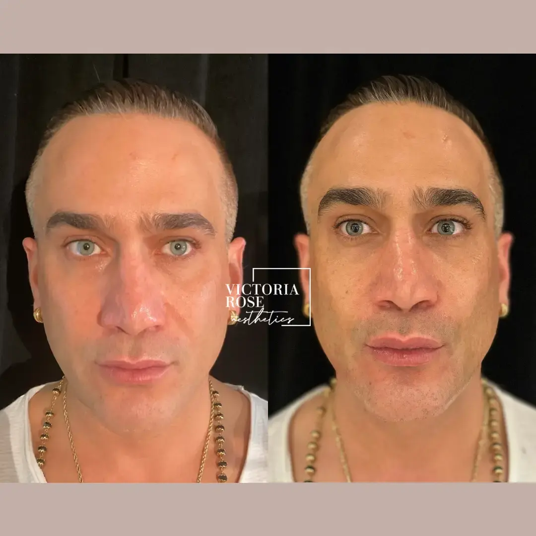 Jawline contouring before and after