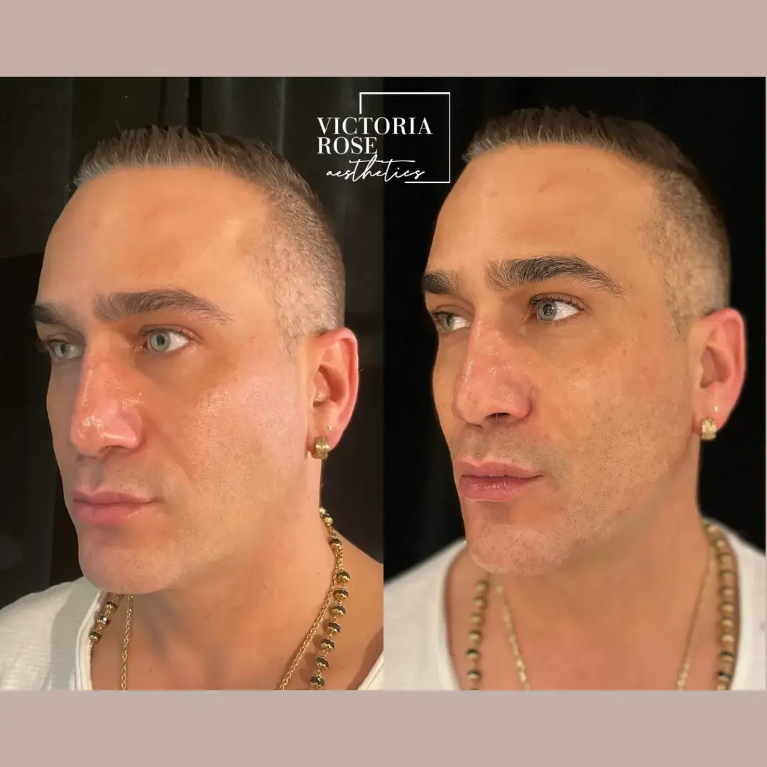 Jawline contouring before and after