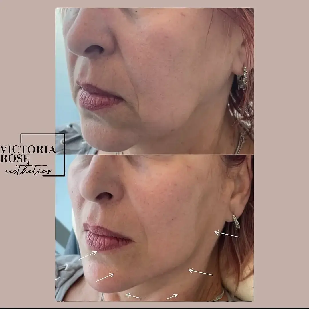 Jawline contouring before and after