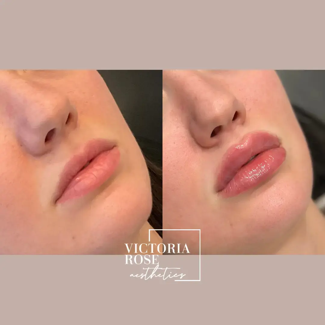 Lip filler before and after