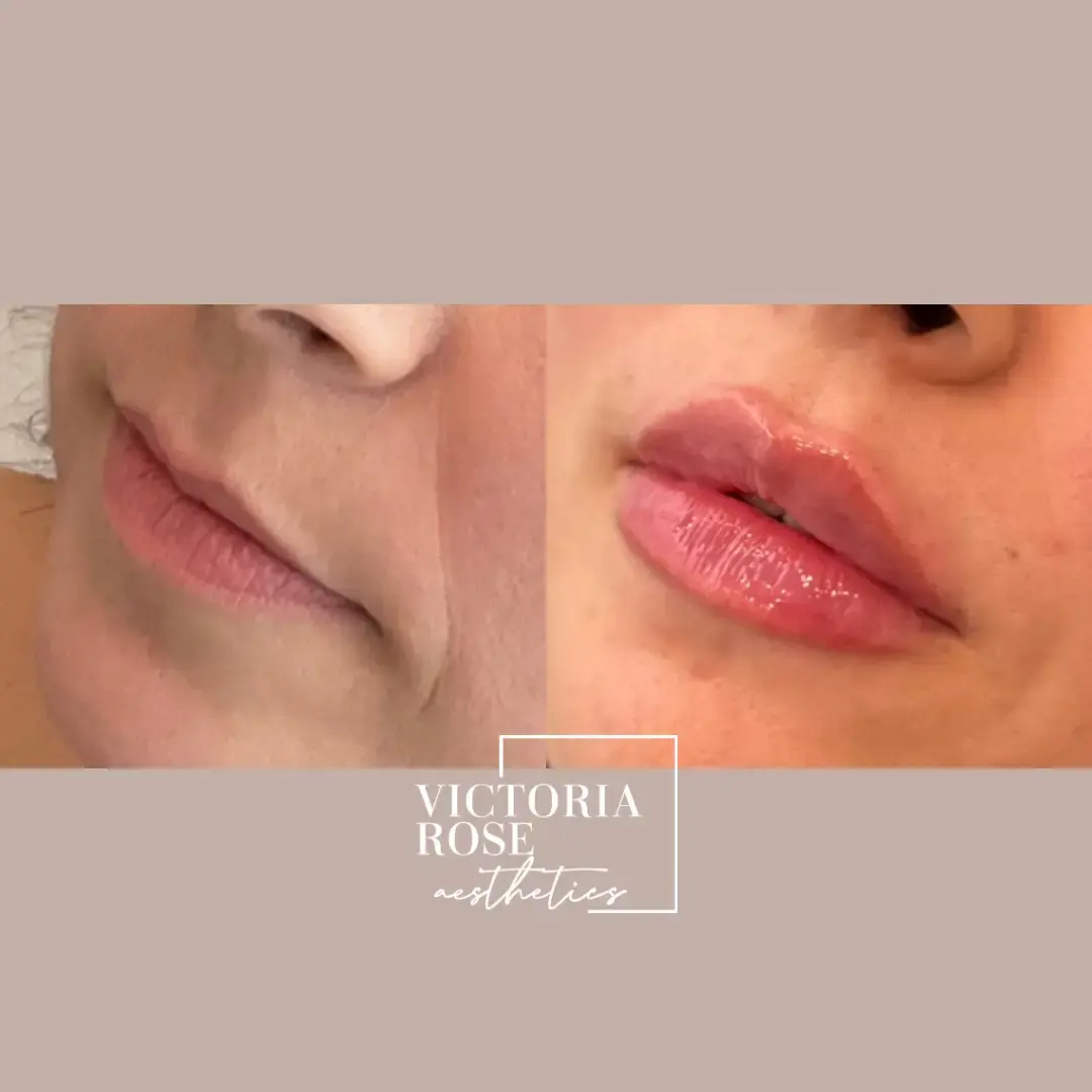 Lip filler before and after
