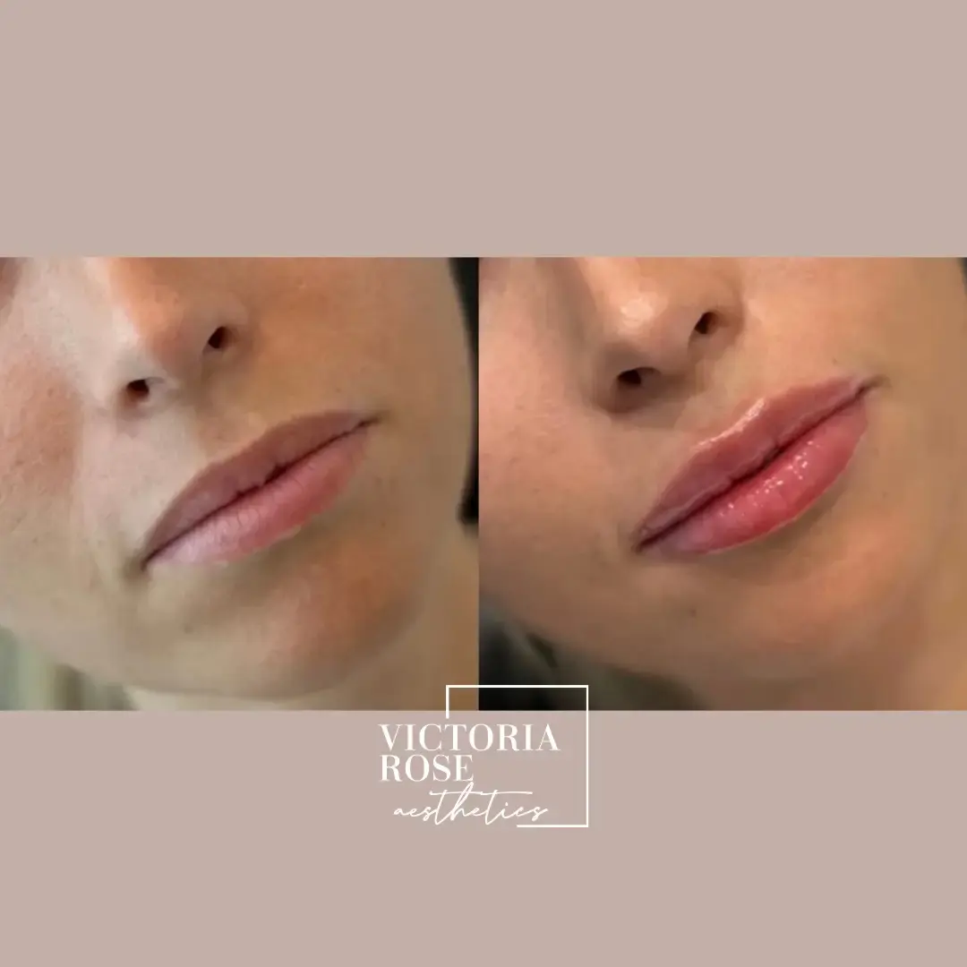 Lip filler before and after