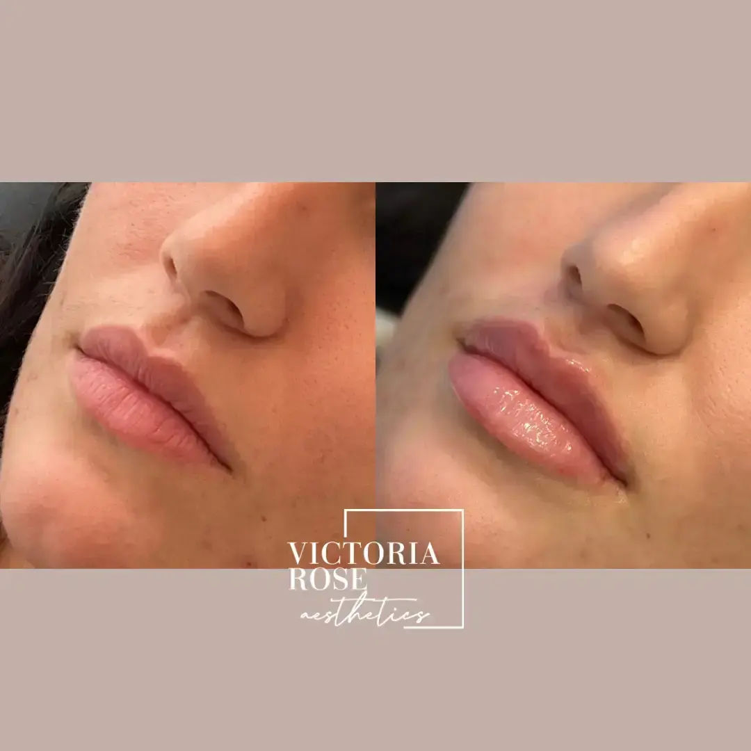 Lip filler before and after