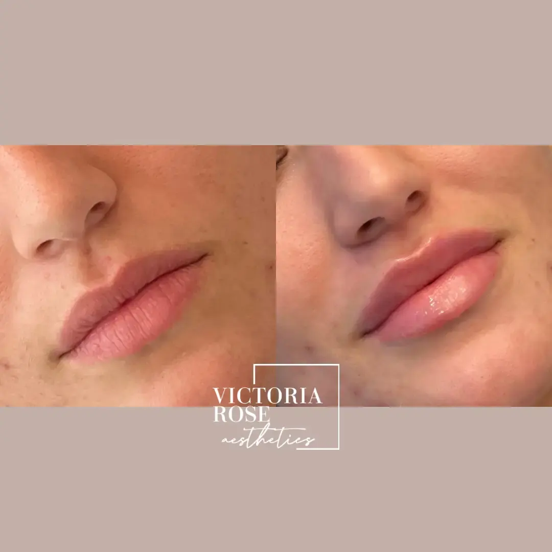 Lip filler before and after