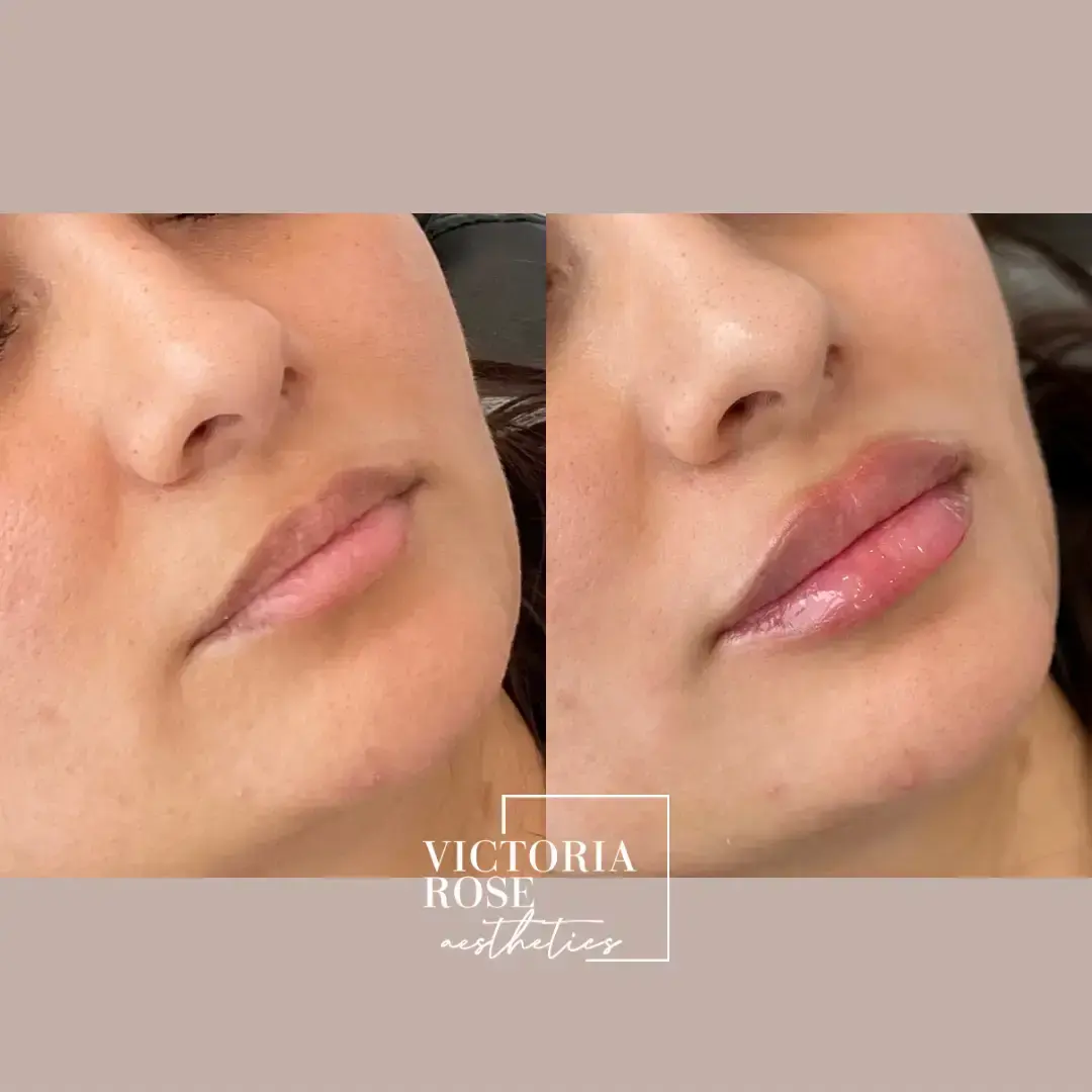 Lip filler before and after