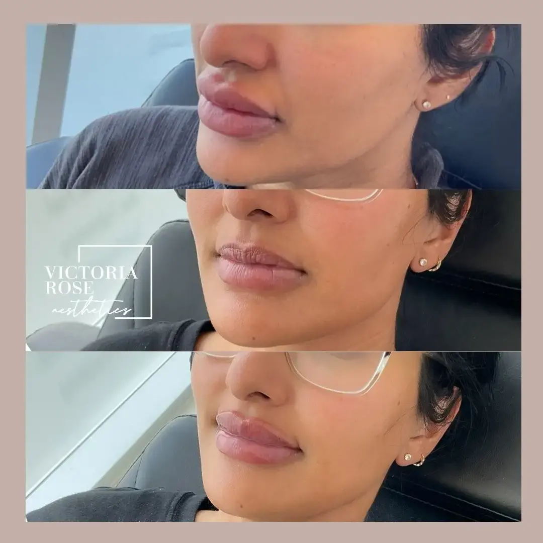 Lip filler before and after