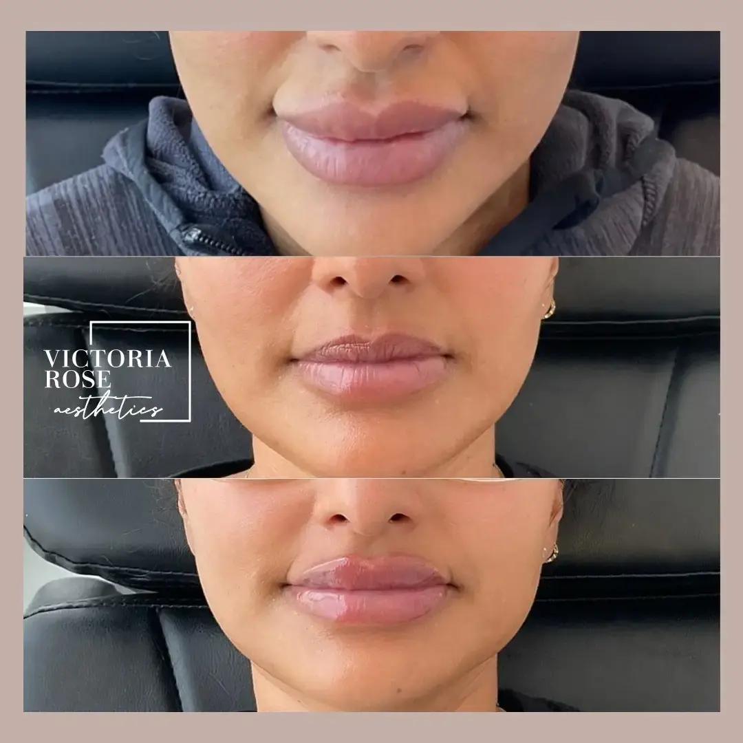 Lip filler before and after