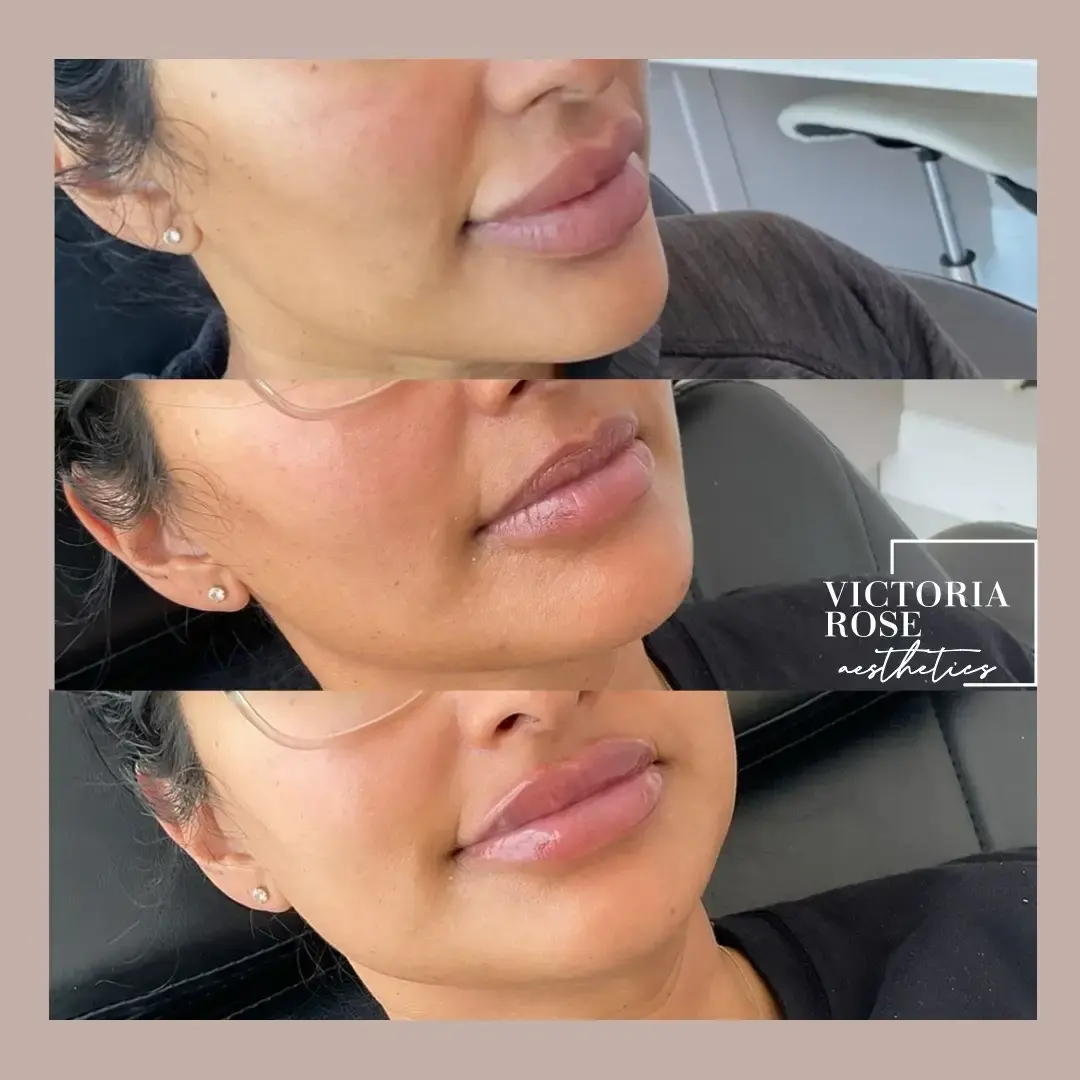 Lip filler before and after