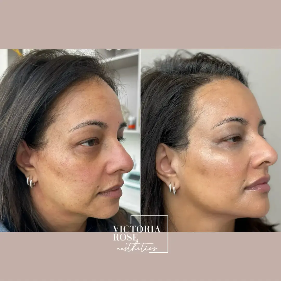 Liquid facelift before and after