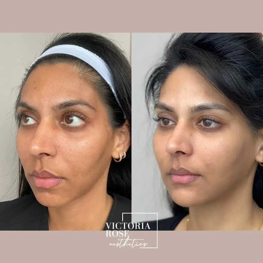 Liquid facelift before and after