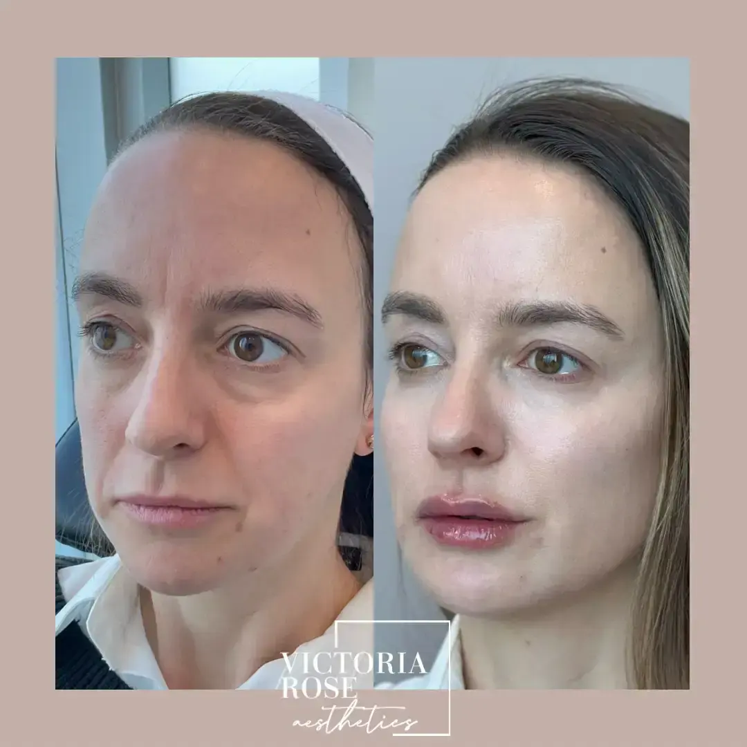 Liquid facelift before and after