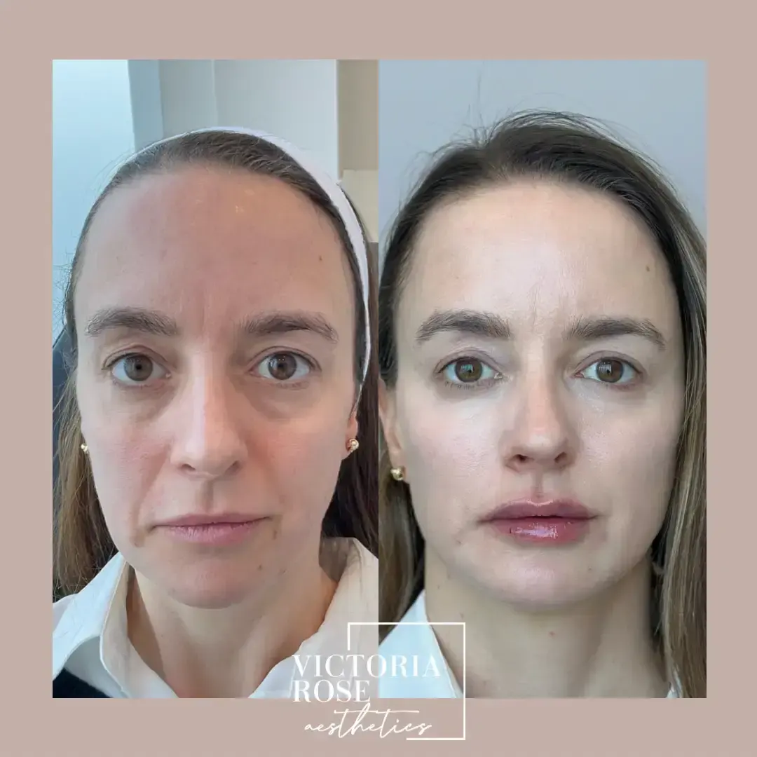 Liquid facelift before and after