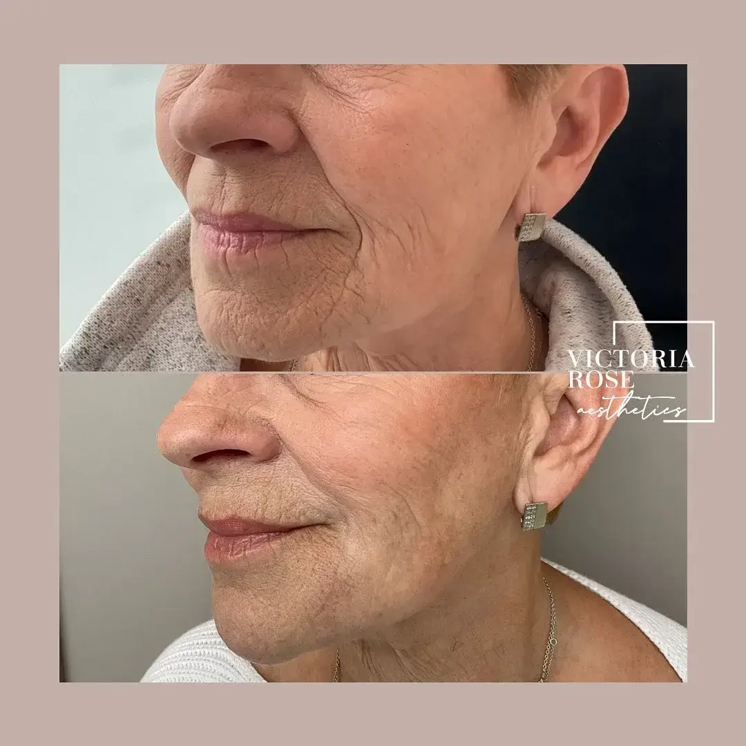 Skin booster microneedling before and after