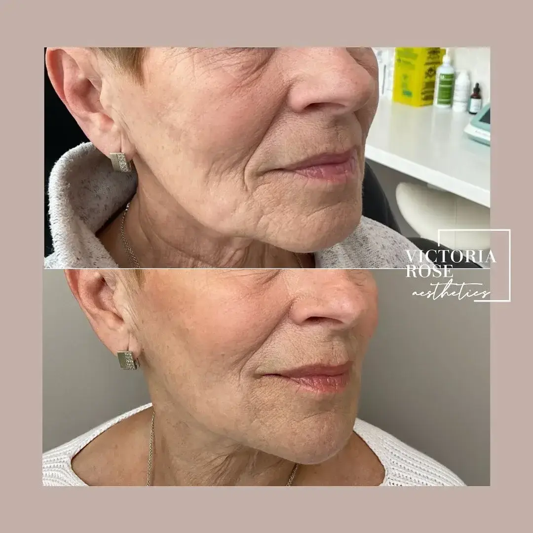 Skin booster microneedling before and after