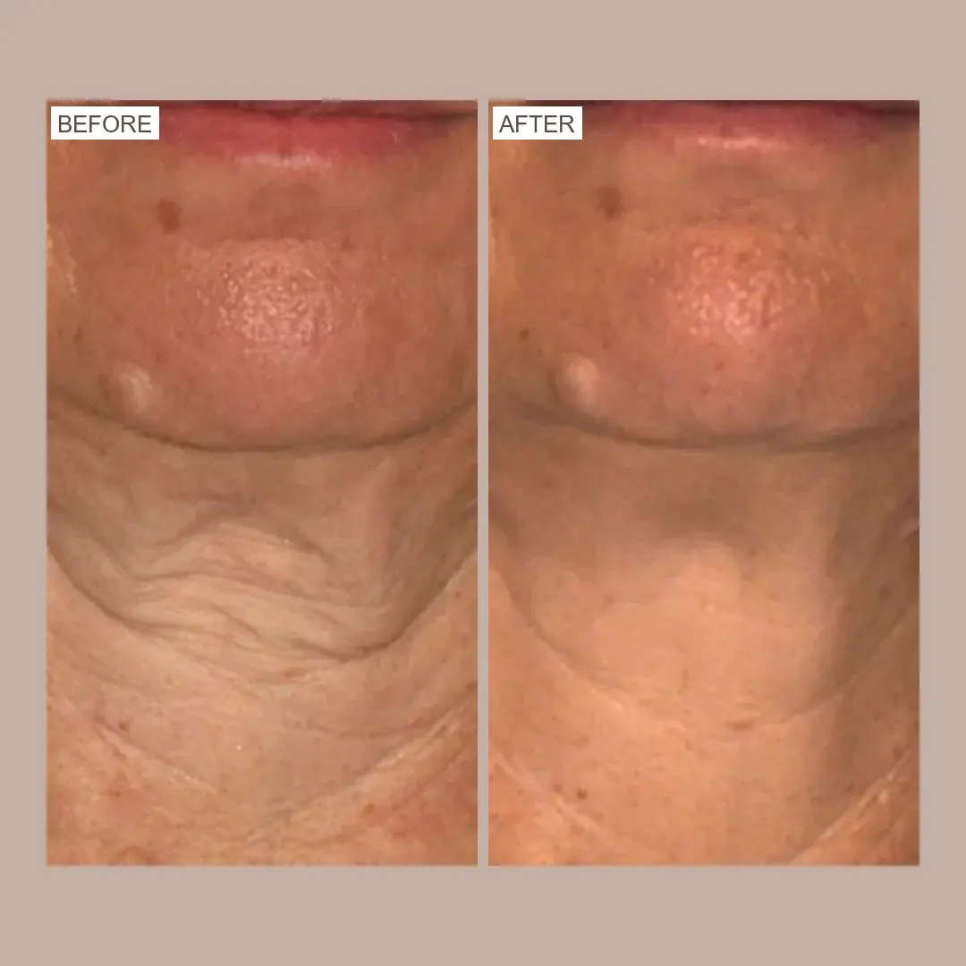 sofwave neck lift before and after