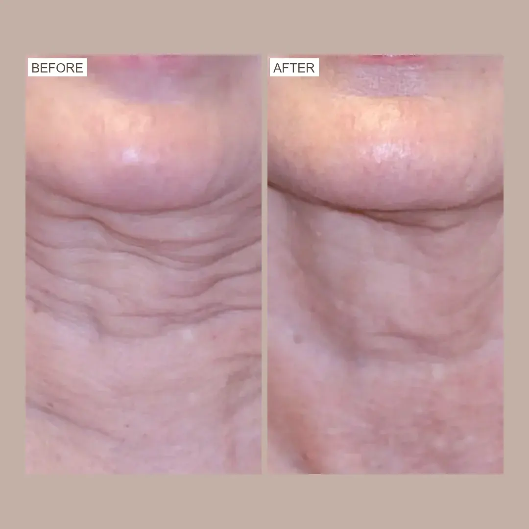 sofwave skin tightening before and after
