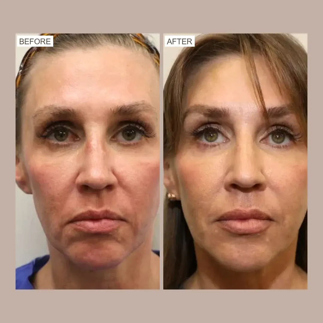 sofwave jowls & lower face before and after