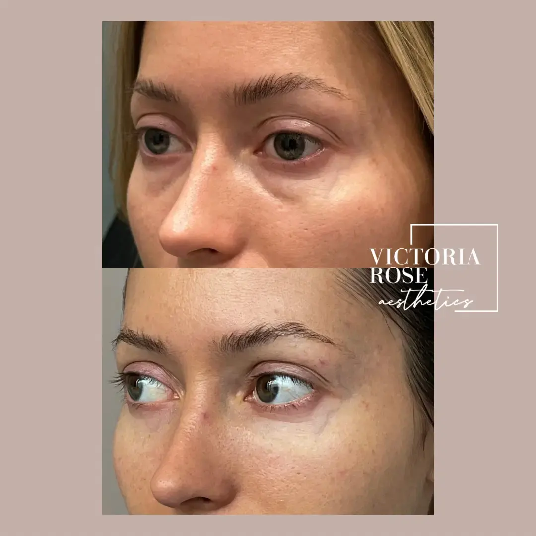 Undereye filler before and after
