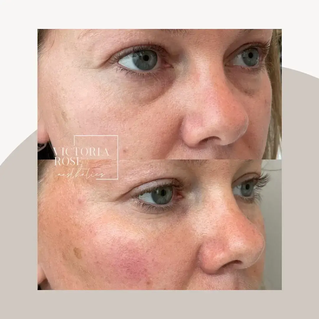 Undereye filler before and after