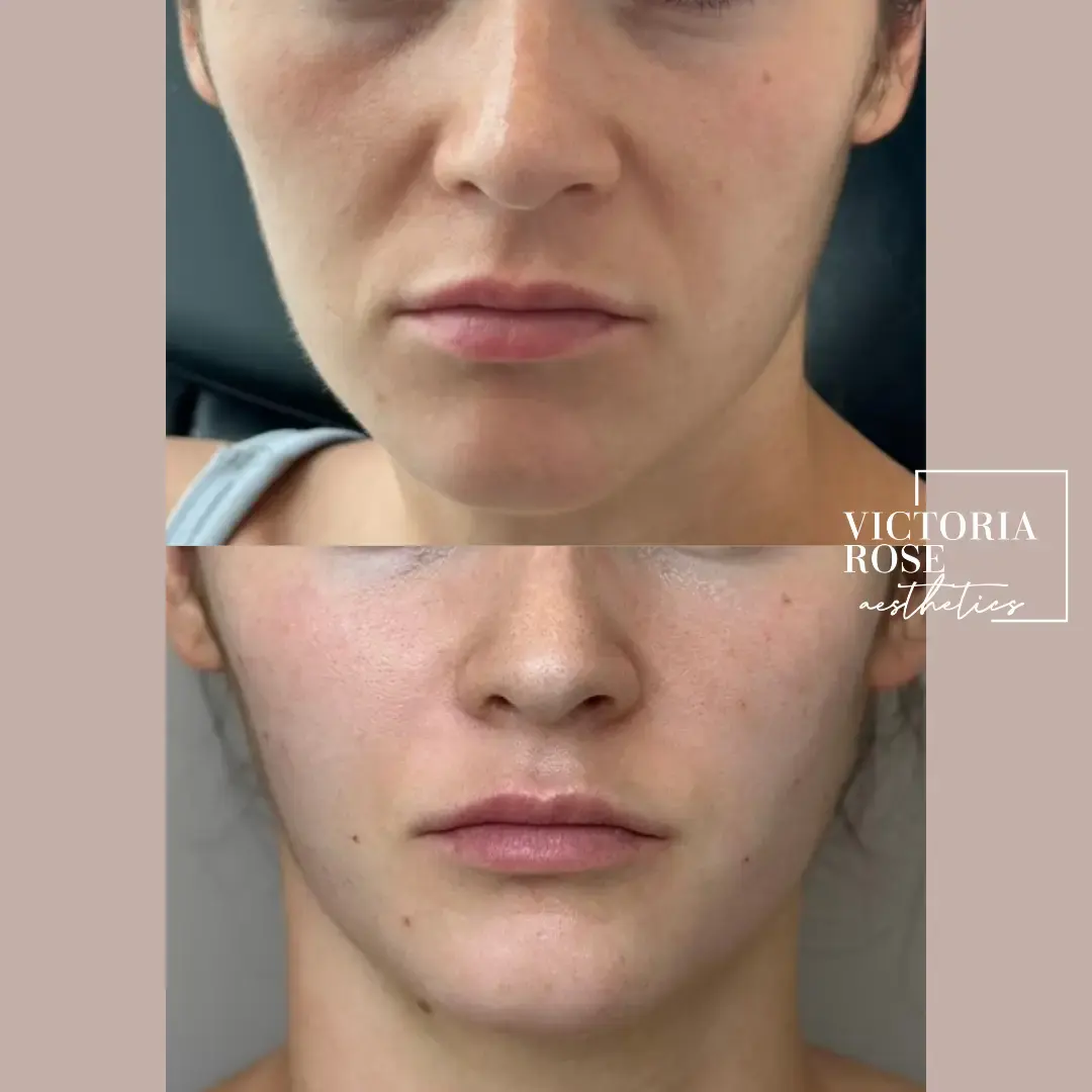 Undereye filler before and after
