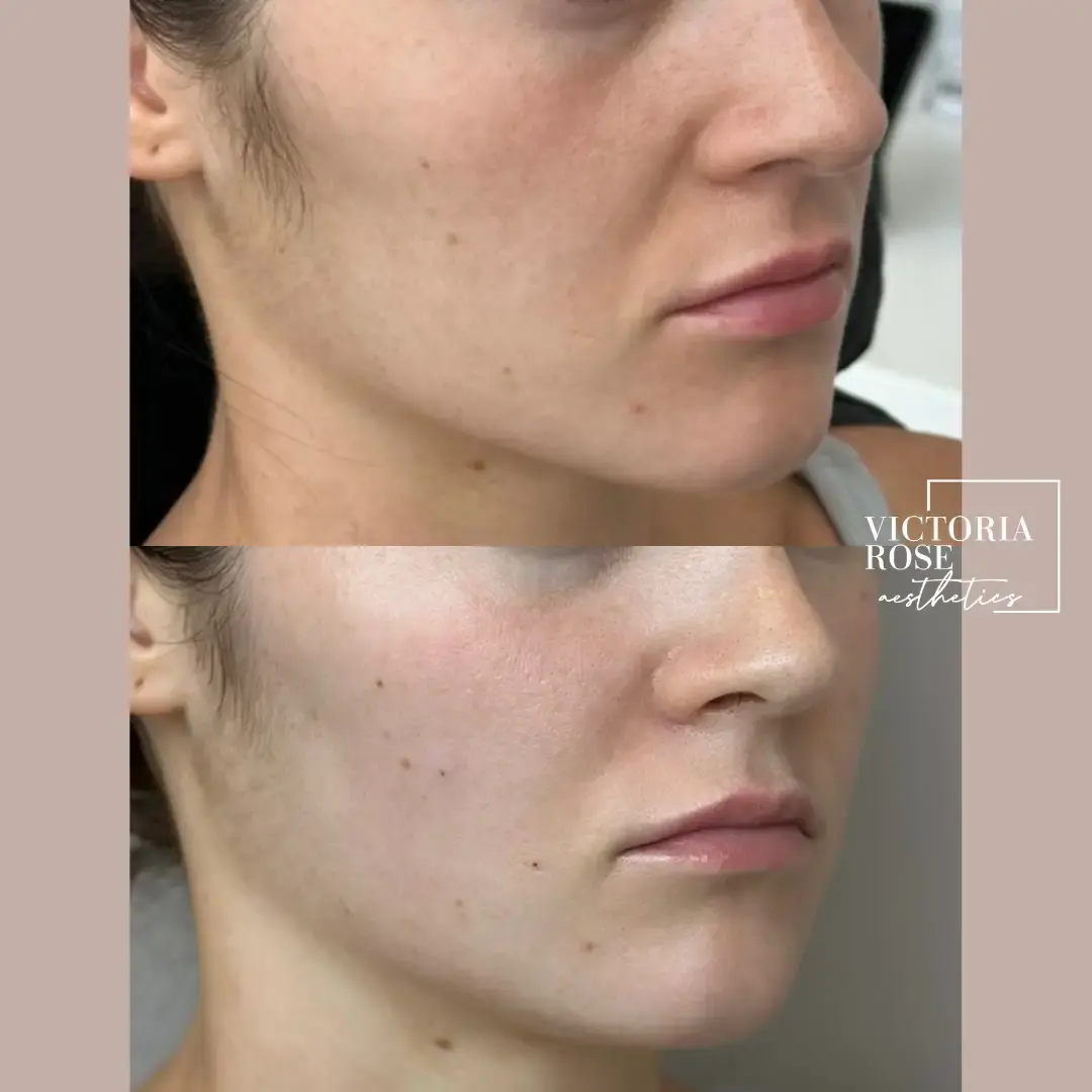 Undereye filler before and after