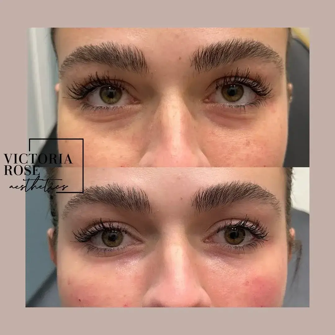 Undereye filler before and after