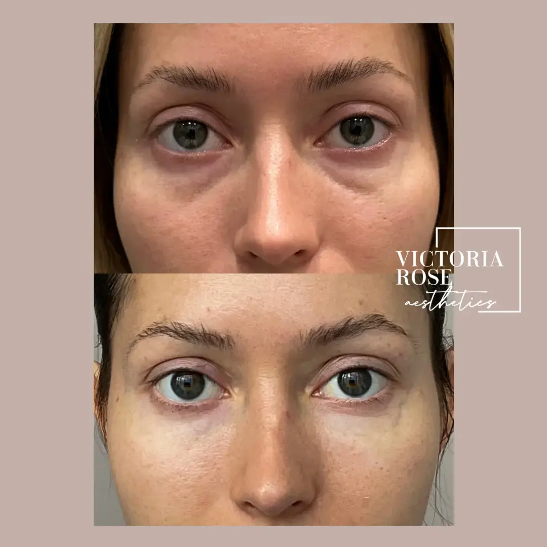 Undereye filler before and after