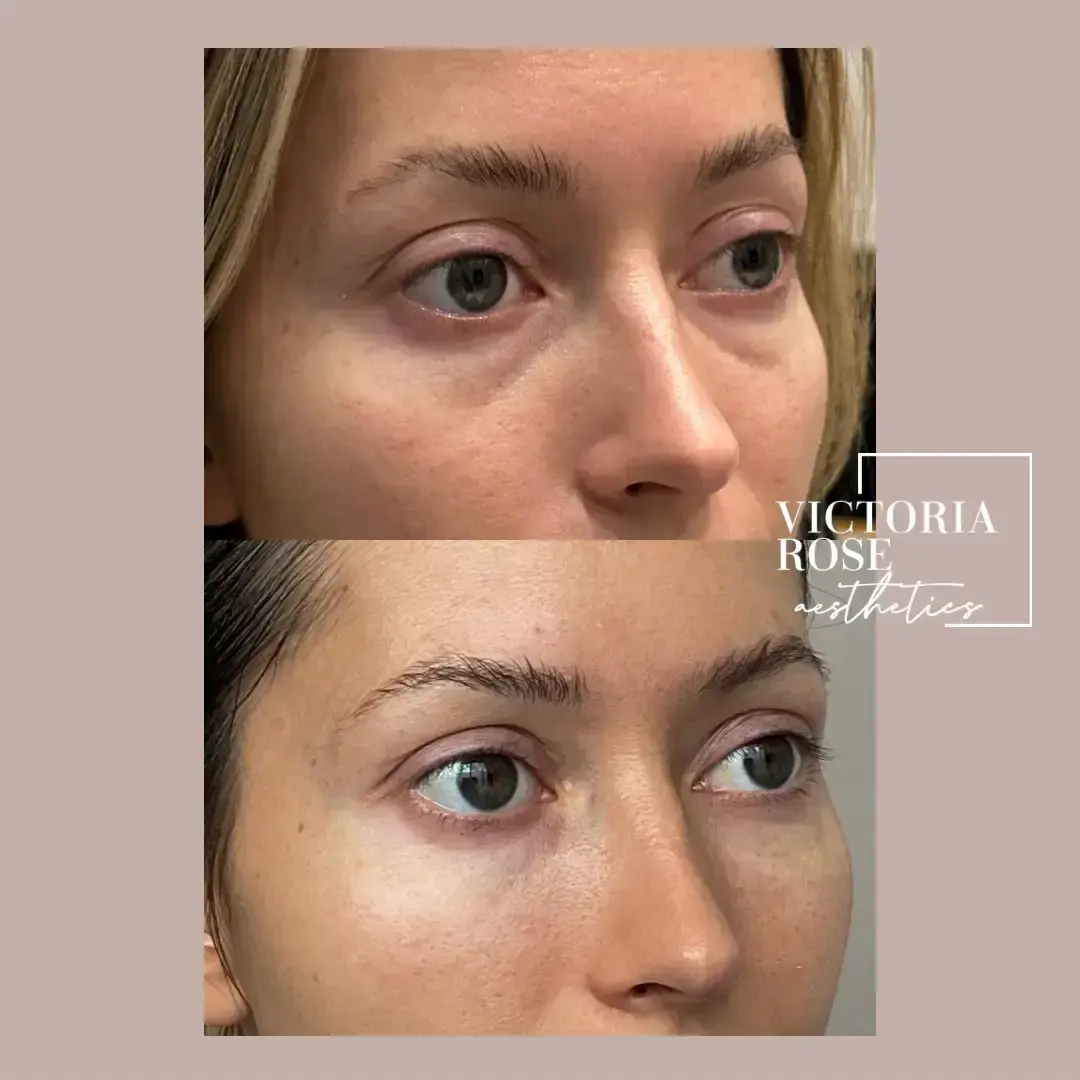 Undereye filler before and after