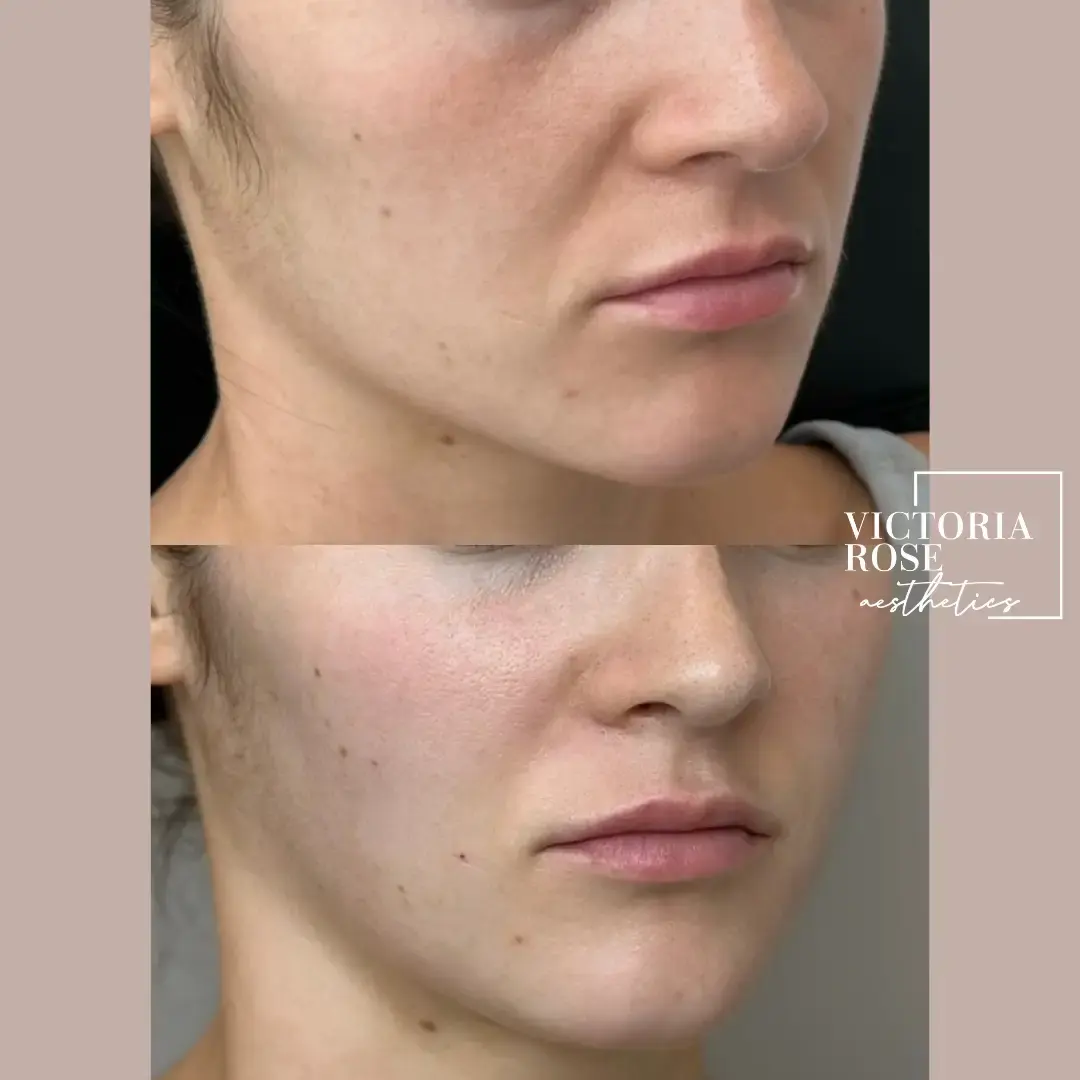 Undereye filler before and after