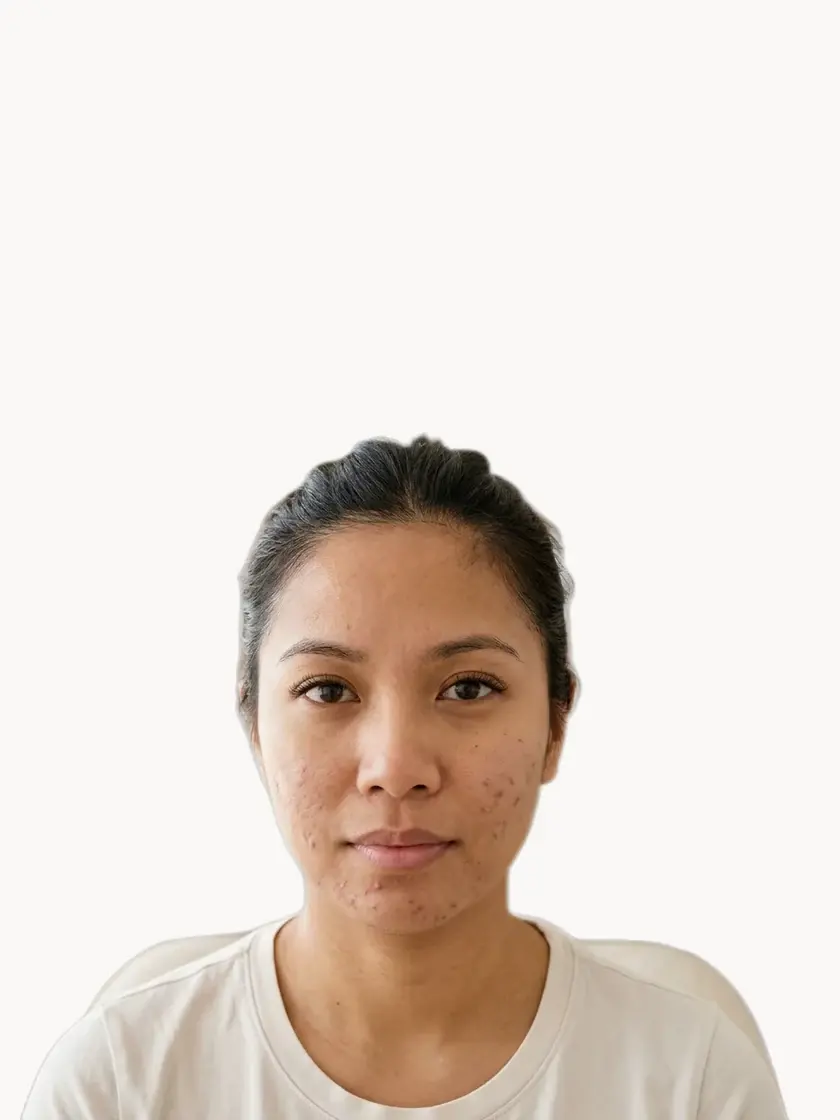 Acne & Breakouts treatment in Pickering